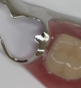 一般的なクラスプ　入れ歯