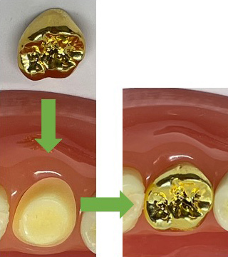 虫歯治療のためのゴールドクラウンって知っていますか？
