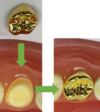 ゴールドクラウン　補綴