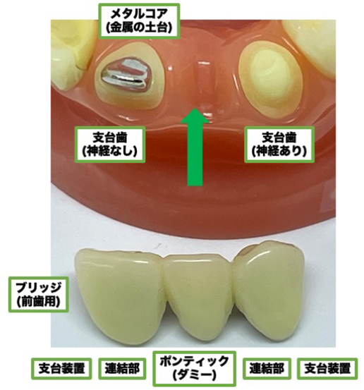 クラウン　ブリッジ　被せ物　技工　歯科