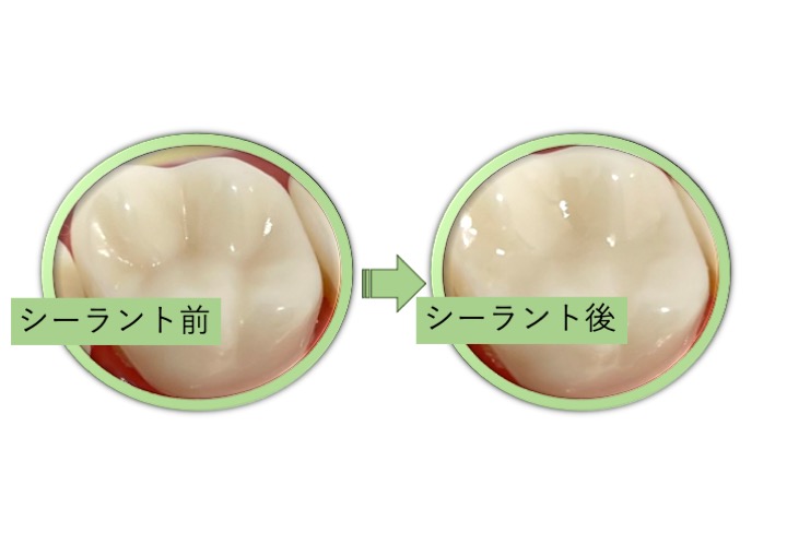 シーラント(予防充填)をご存じですか？