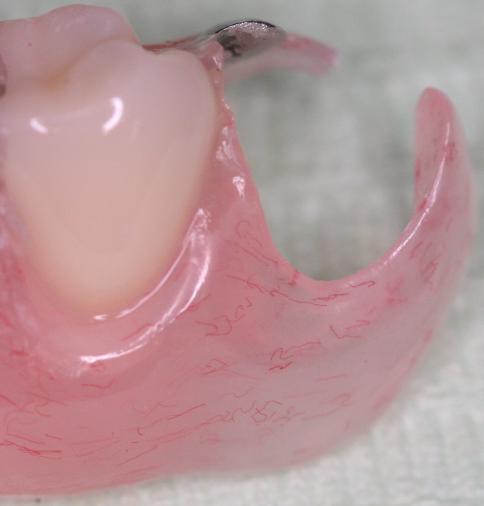 入れ歯について— 入れ歯の材料