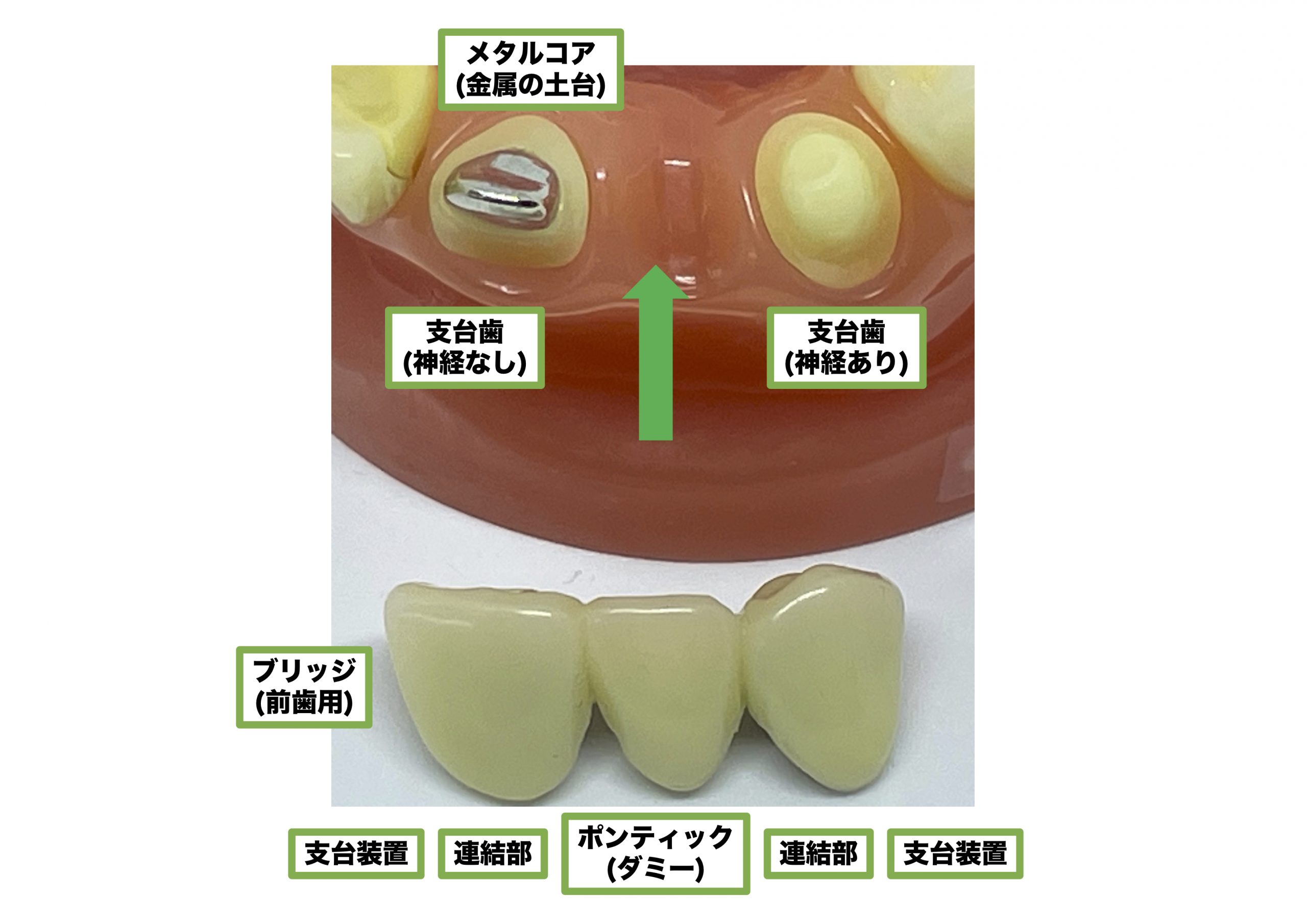 ブリッジのポンティックの基底面(下面)とは？