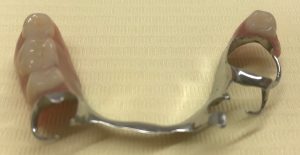 保険で製作する義歯(入れ歯)の例