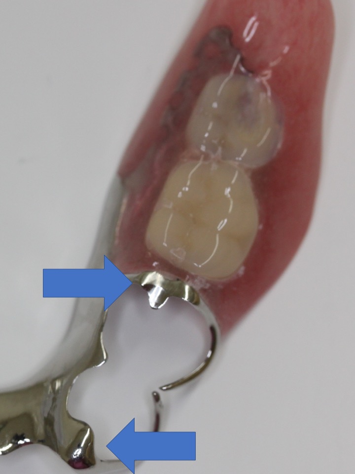 入れ歯: 入れ歯の針金の部分のお話