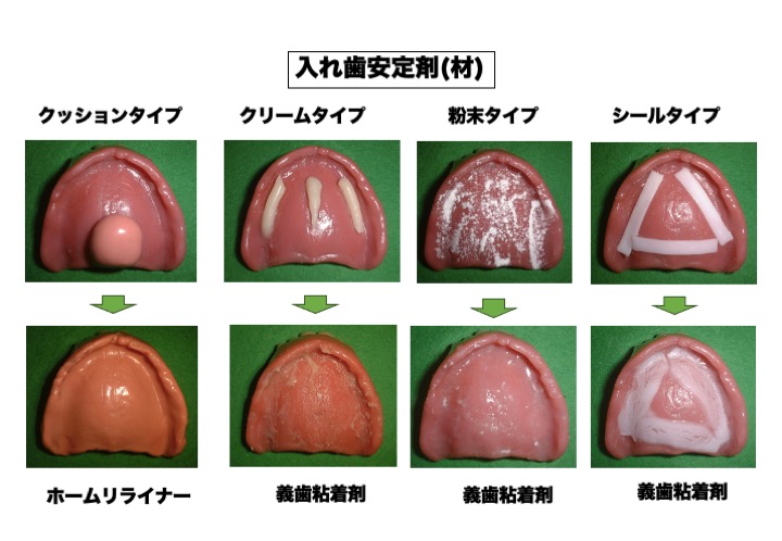 入れ歯安定剤? 入れ歯安定材？