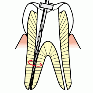 根管治療