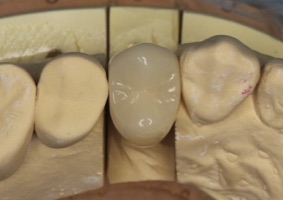小臼歯のCAD/CAM冠